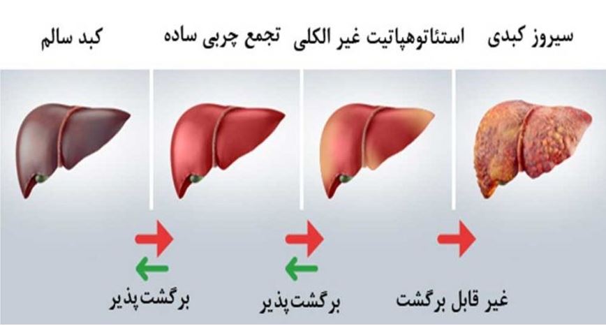 کبدچرب